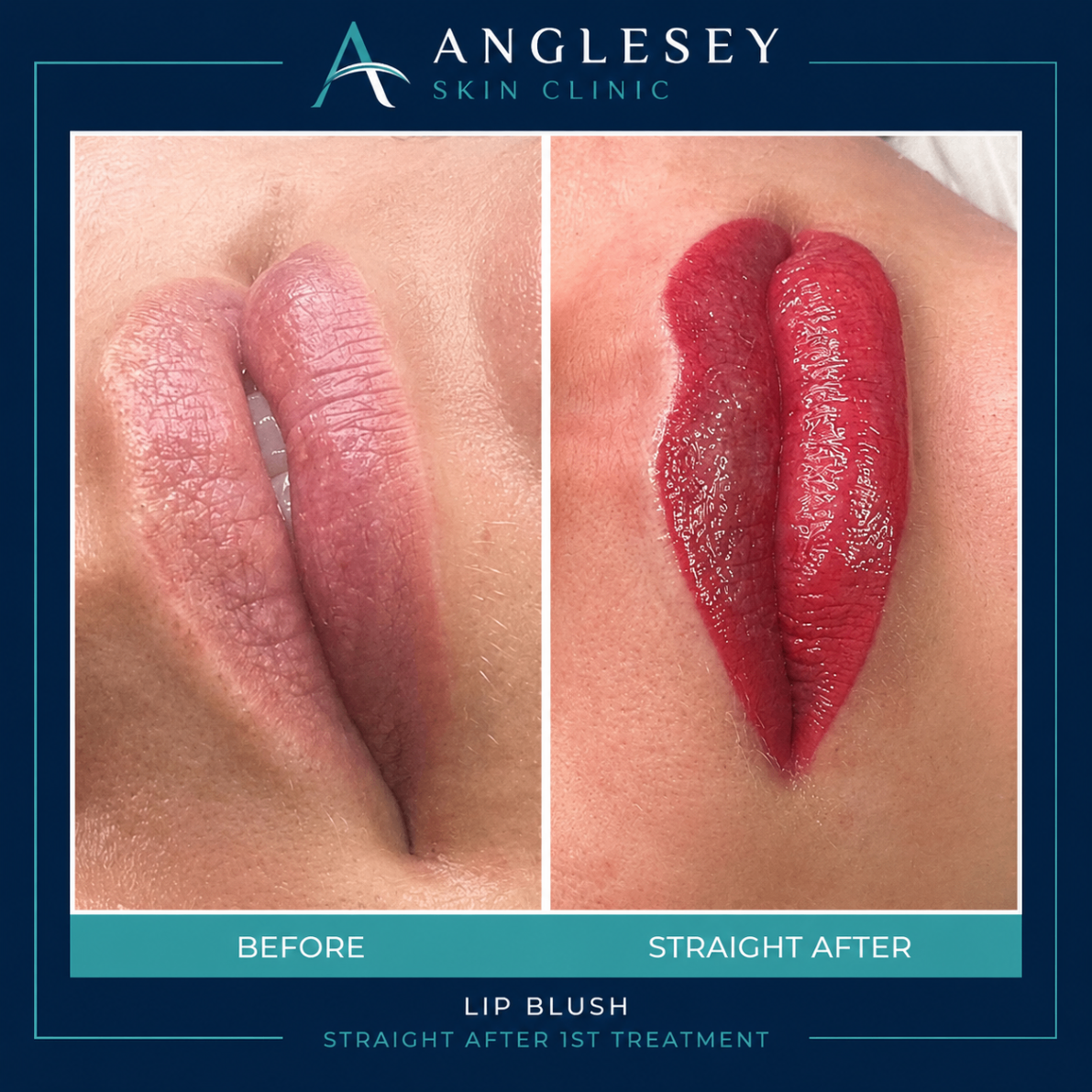 Lip blush result showing before and straight after treatment