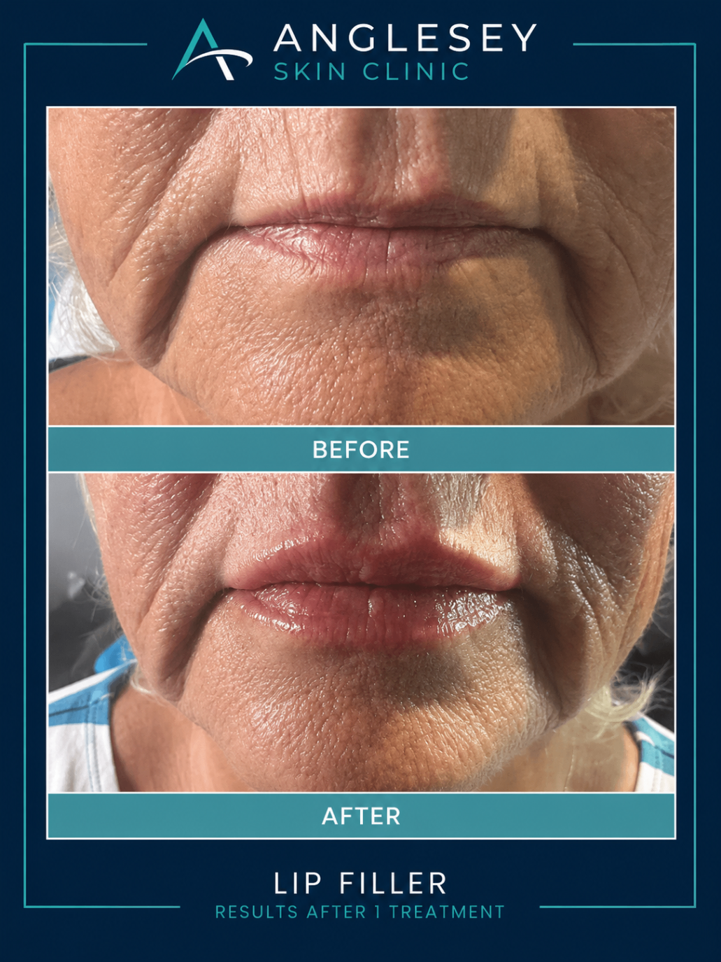 Lip filler result showing before and after enhancement