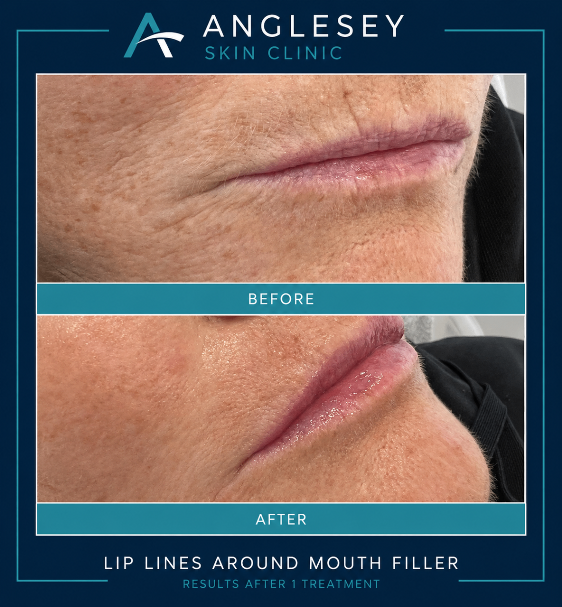 Lip line filler result showing before and after improvement around the mouth