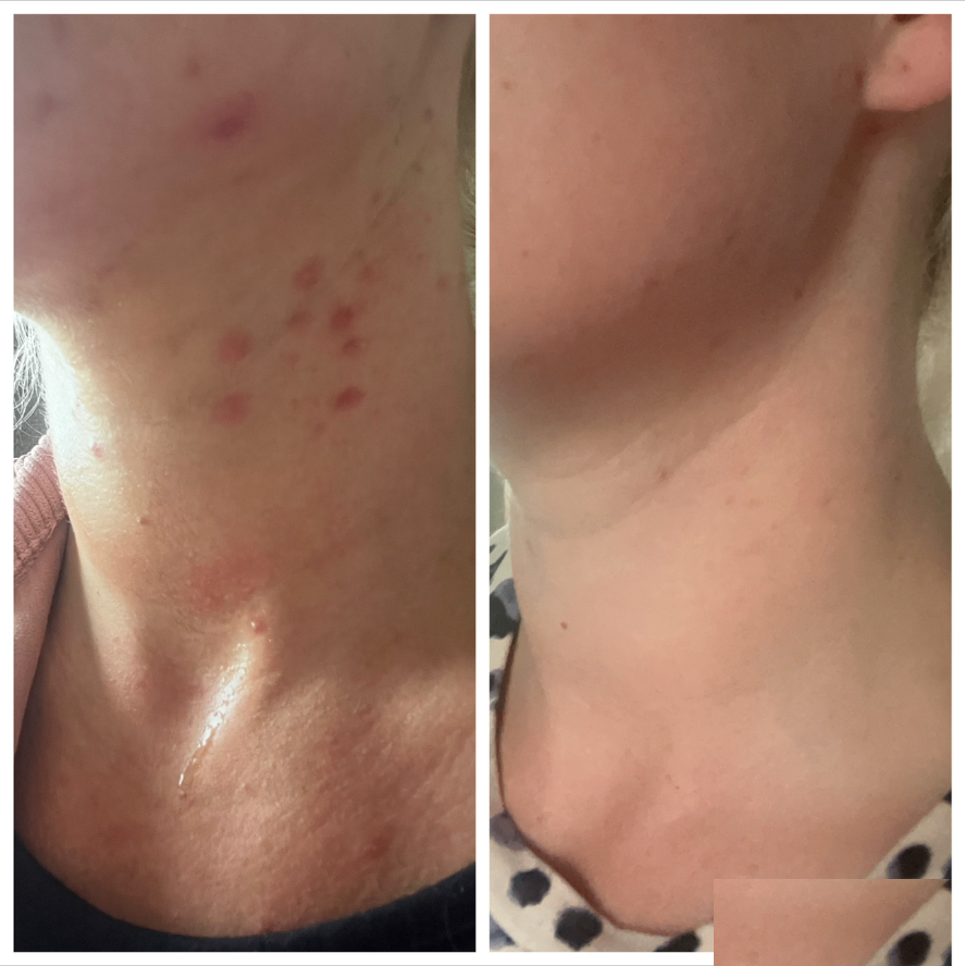 Acne improvement result showing progress after a few treatments