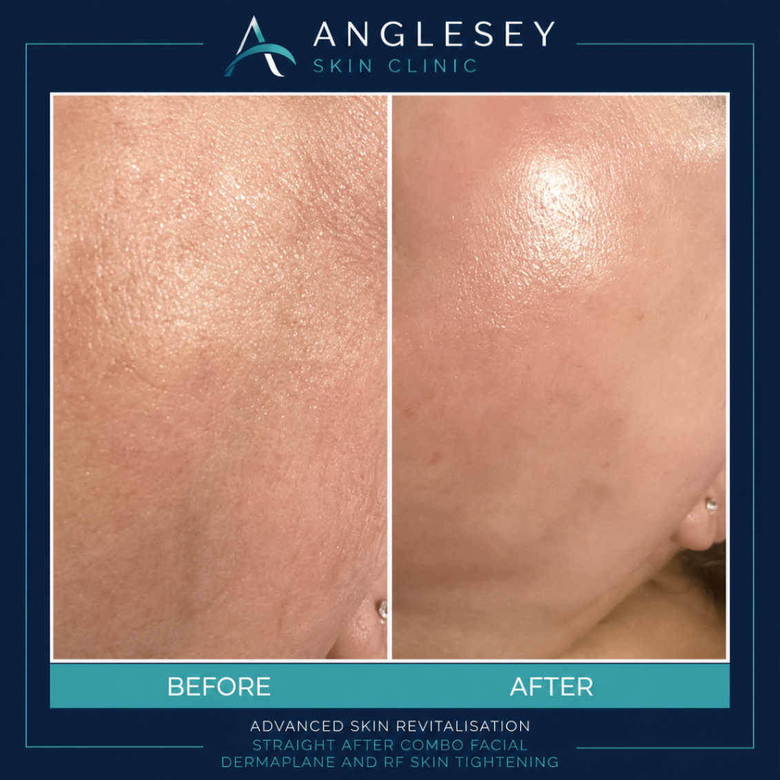 Advanced skin revitalisation result after combo facial dermaplane and RF skin tightening